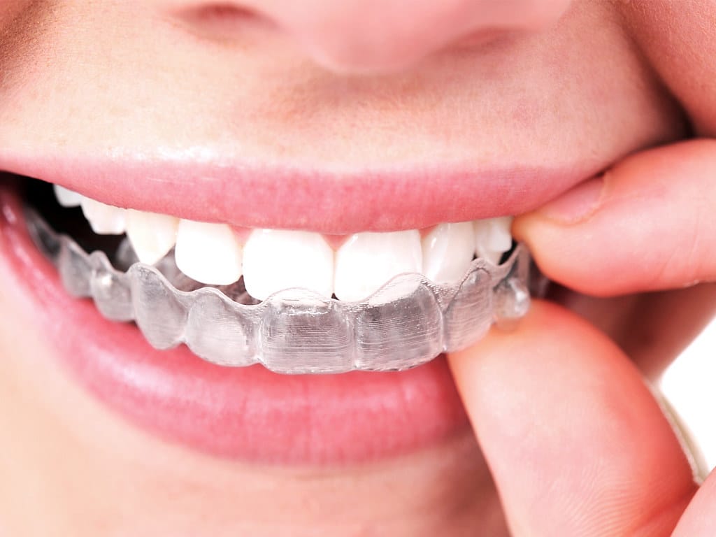 upper east side dentistry manhattan invisalign