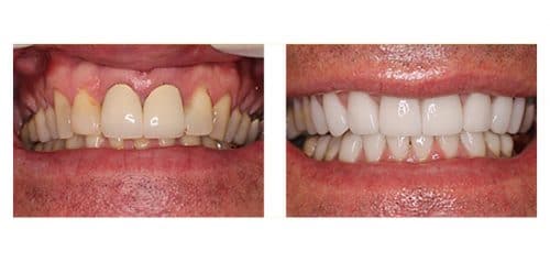 Veneers Before and After from Dr. Lattinelli