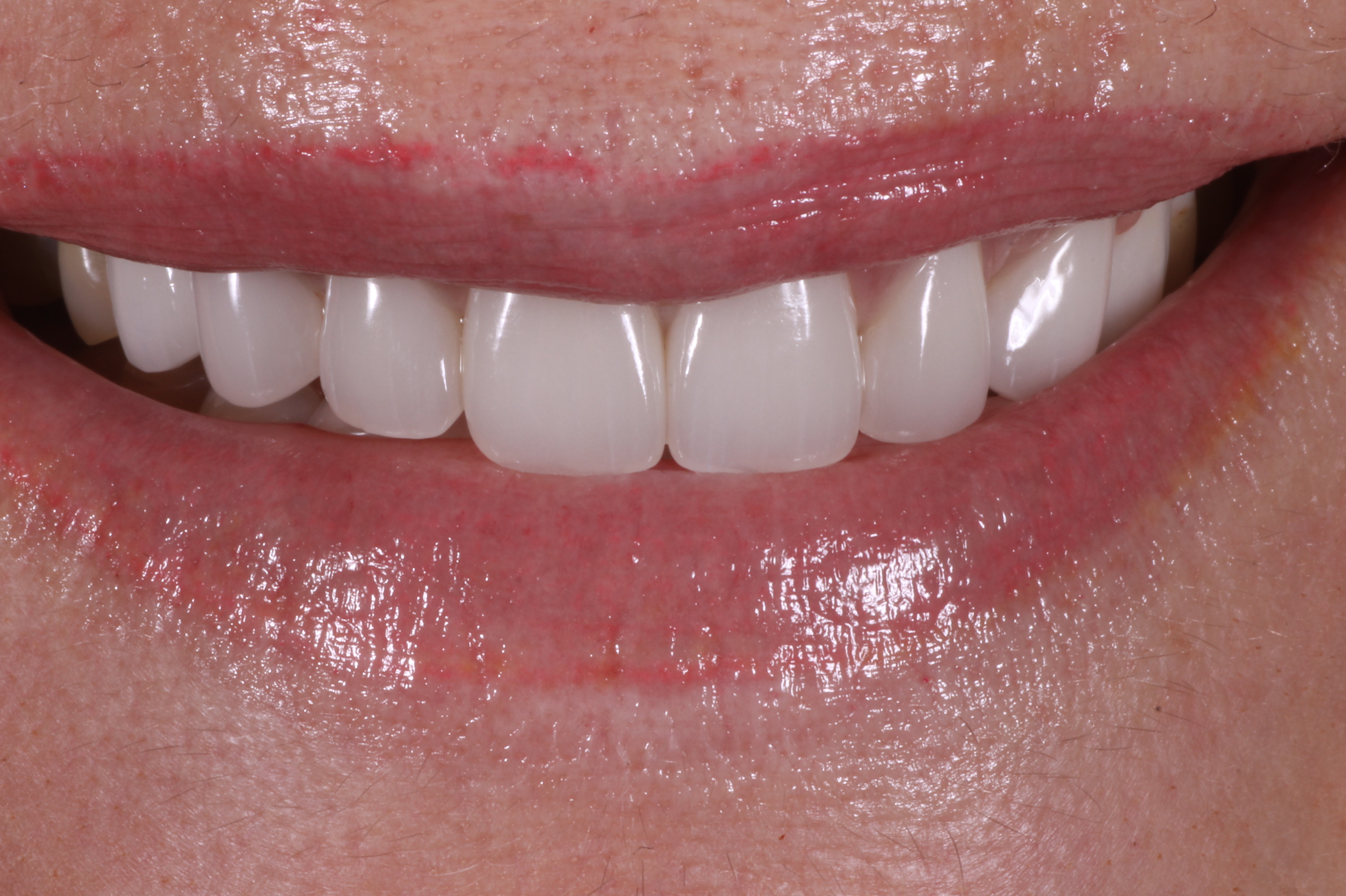 Before and After Porcelain Veneers
