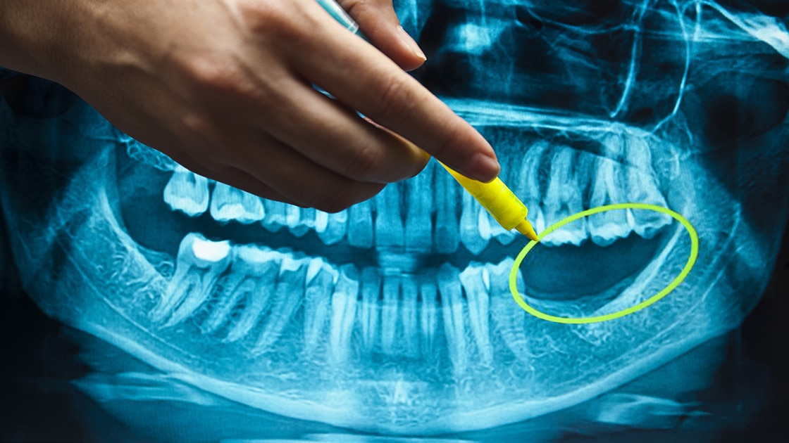 dental x-ray highlighting missing teeth and jaw bone resorption