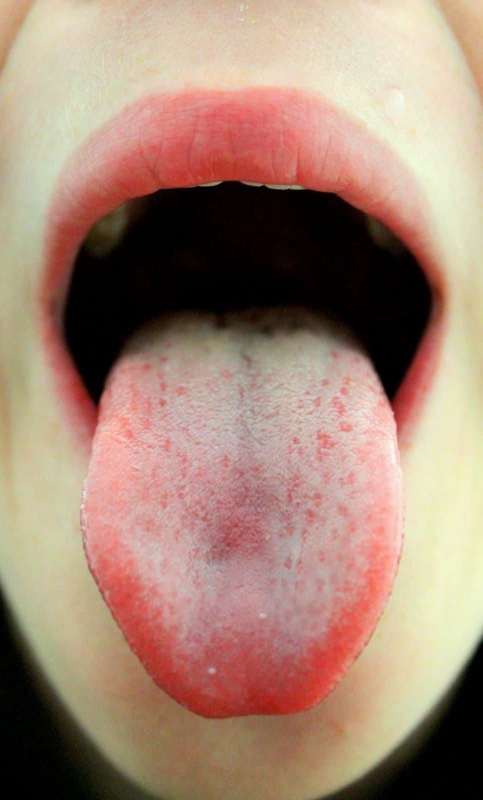 white tongue from smoking cigarettes Manhattan Cosmetic Dentistry | Upper East Side Dentist