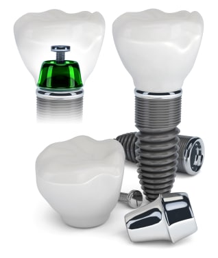 Upper East dental implants