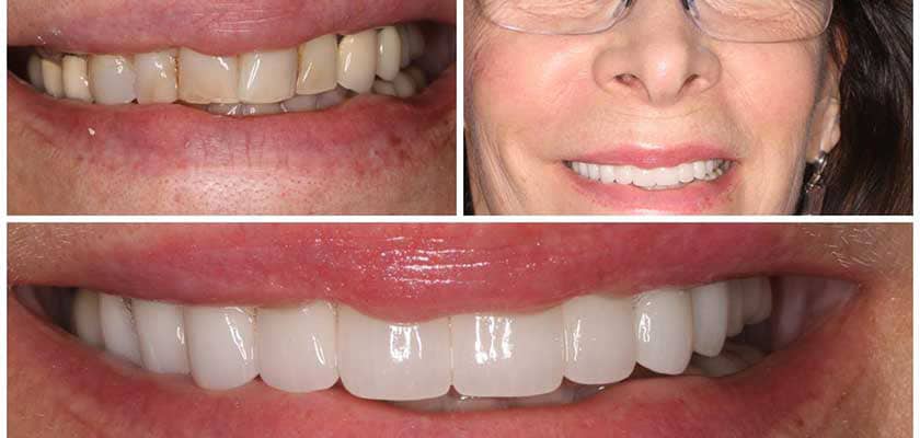 before and after of cosmetic dentistry in nyc
