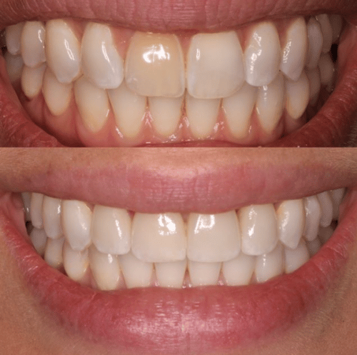 Before and After Porcelain Veneers