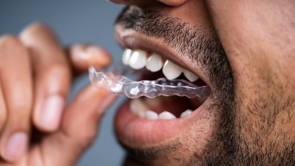 man inserting clear tooth aligner