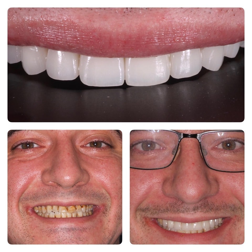 Cosmetic Dentistry Before and After from Dr. Lattinelli in Manhattan