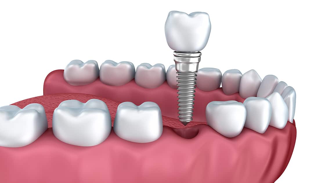 Dental Implant Restorations Image
