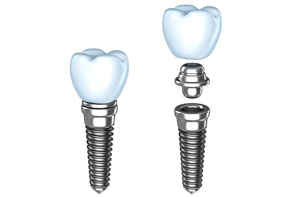 Midtown NY Dental Implants