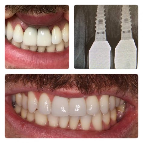 Dental Implants from Dr Lattinelli