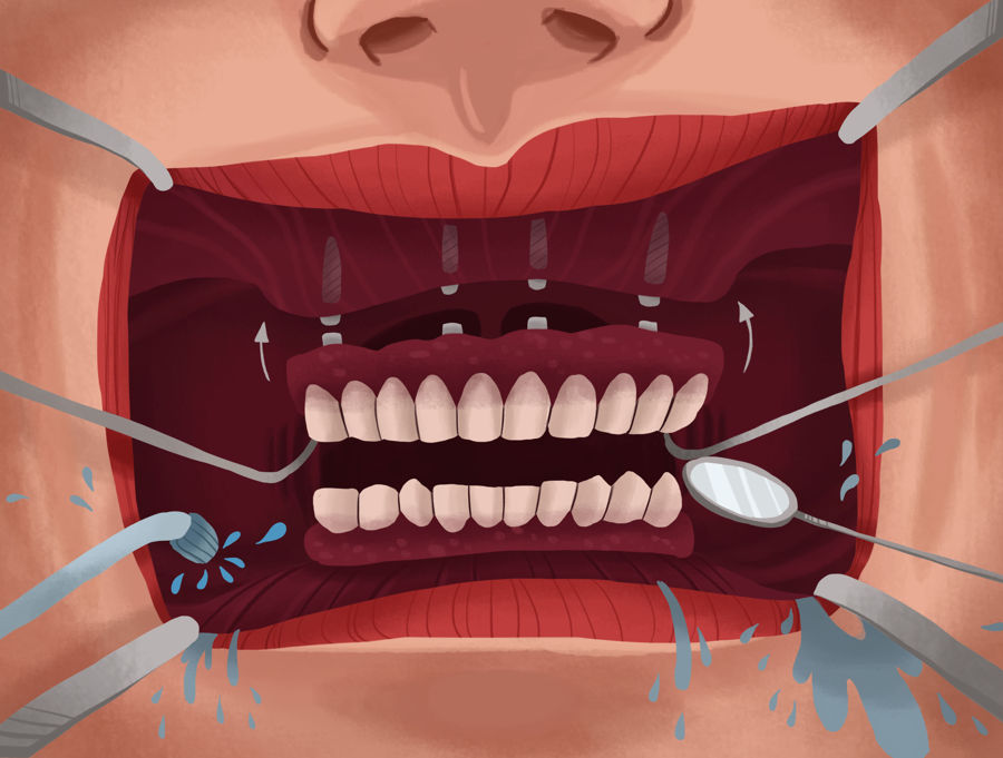 dental implants manhattan
