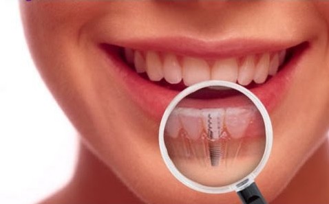 Midtown NY Dental Implants