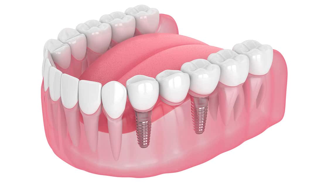 Implant Supported Bridges Graphic