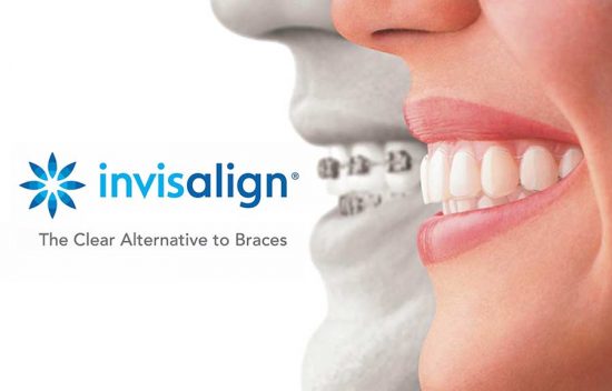 Invisalign Manhattan