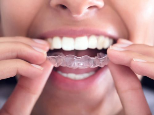 Upper East Side Invisalign