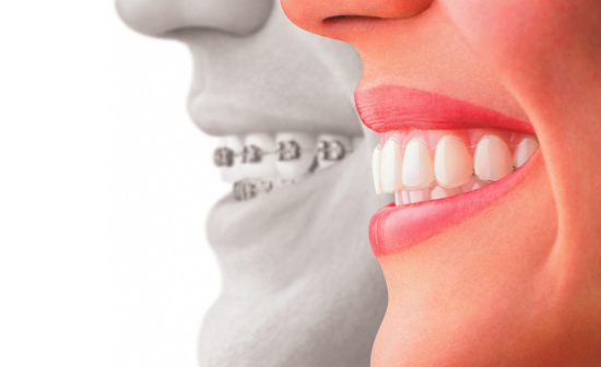 upper east side invisalign