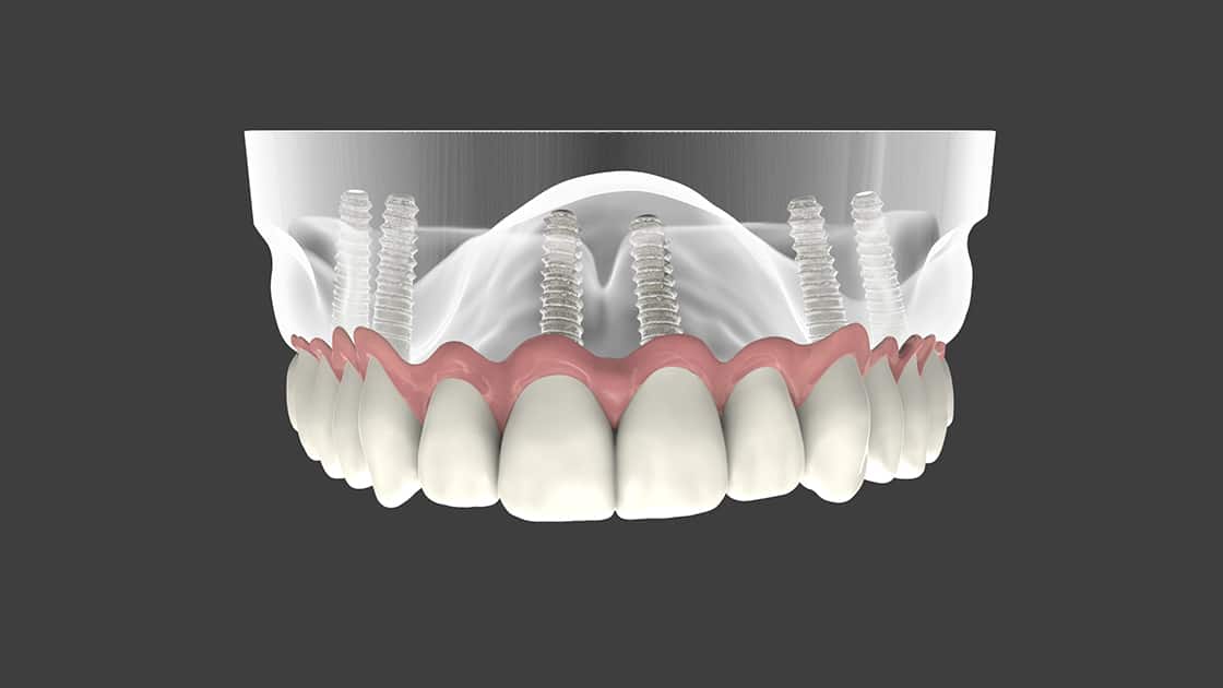 Mini Dental Implants Graphic