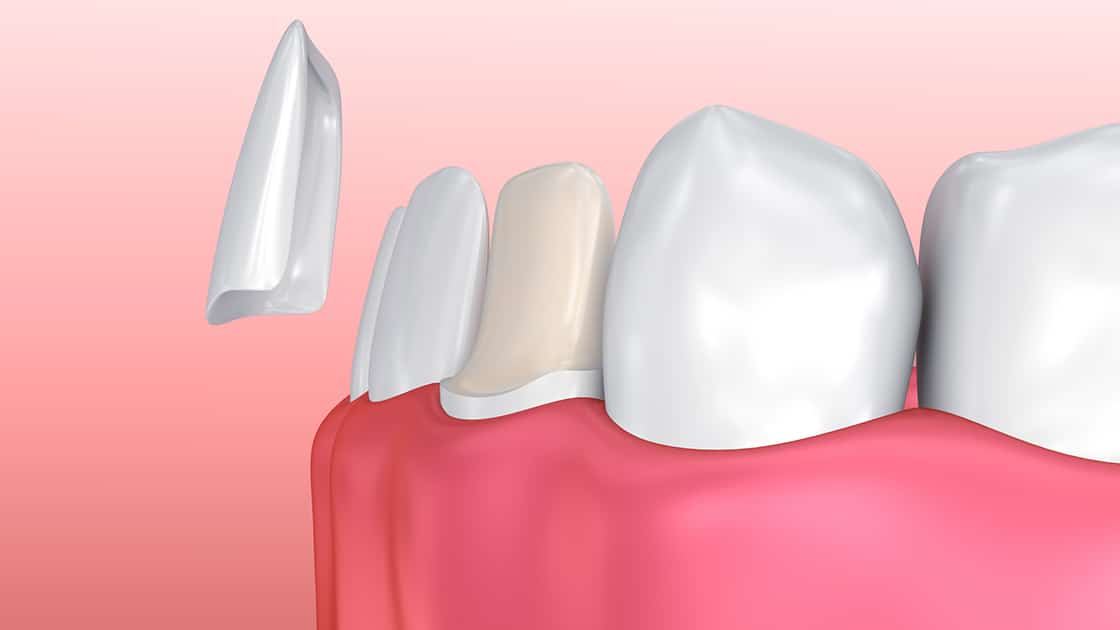 graphic of tooth veneers