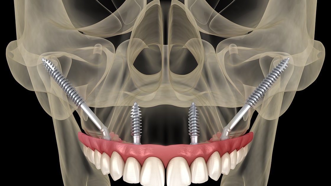 Zygoma Implants x-ray graphic